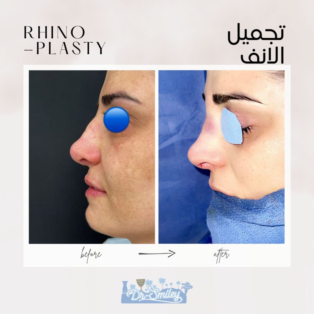 Rhinoplasty before and after