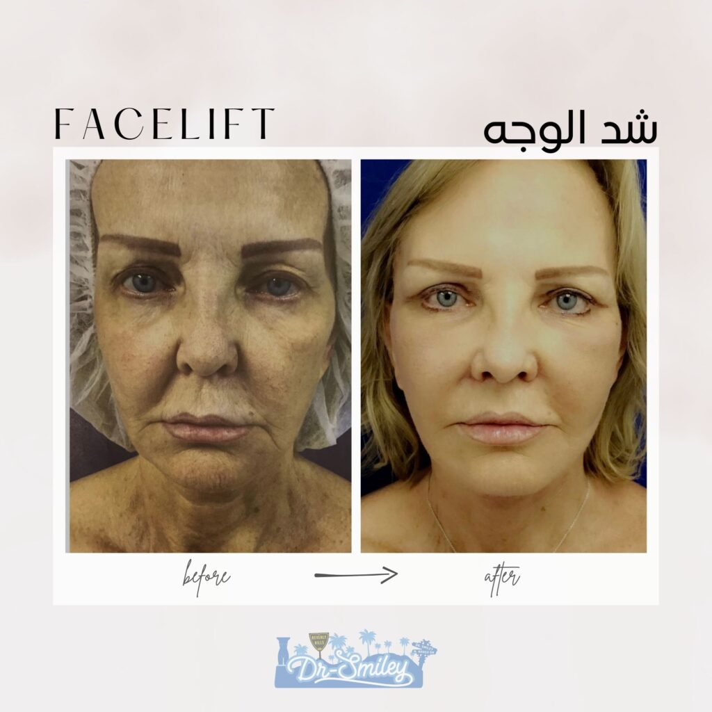 Facelift before and after
