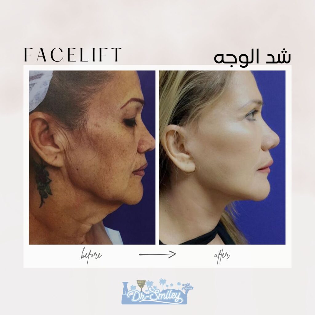 Facelift before and after