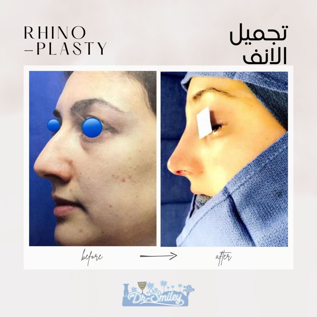 Rhinoplasty before and after