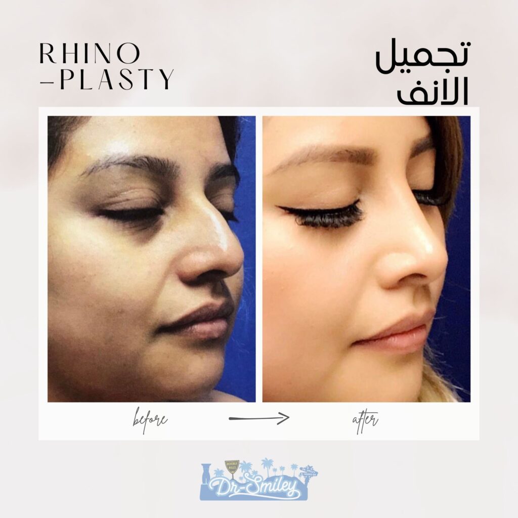 Rhinoplasty before and after