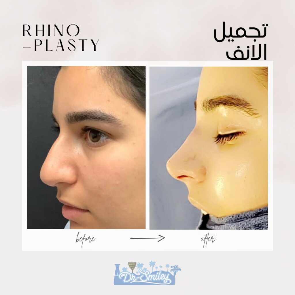 Rhinoplasty before and after