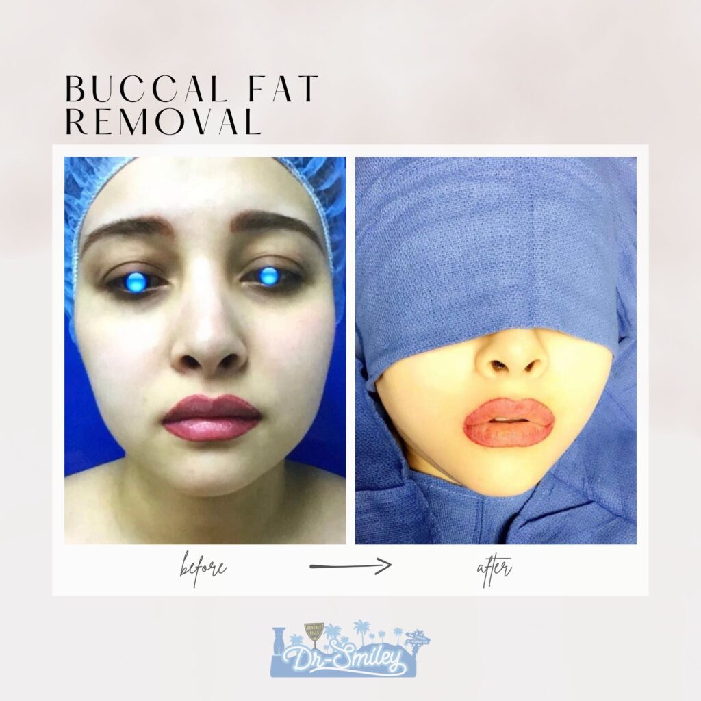 Buccal Fat Removal before and after