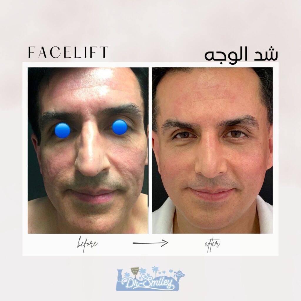 Facelift before and after
