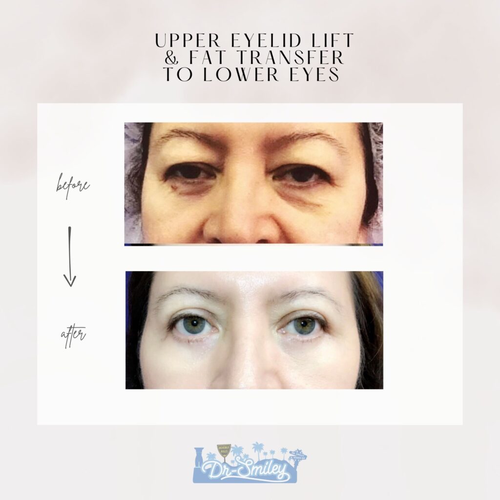 Eyelid Lift before and after
