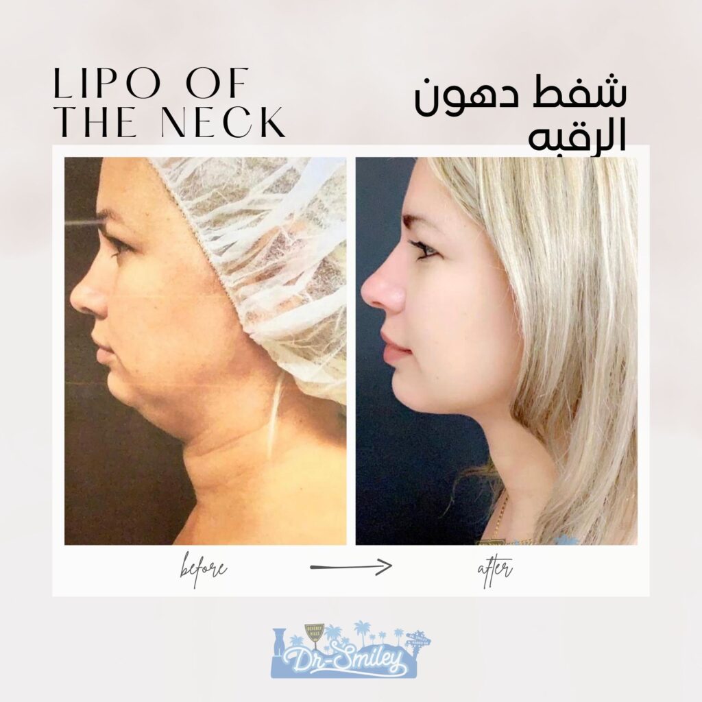 Neck Liposuction before and after